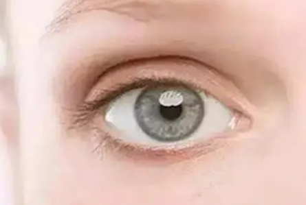 眼袋