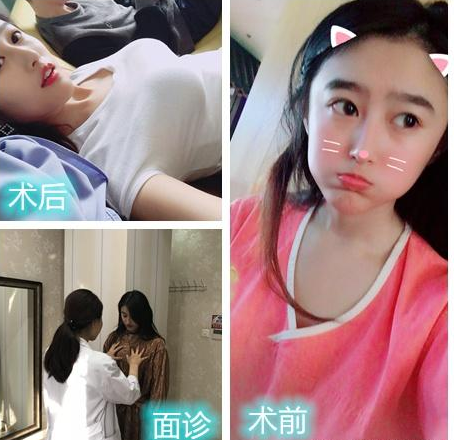 自体脂肪丰胸