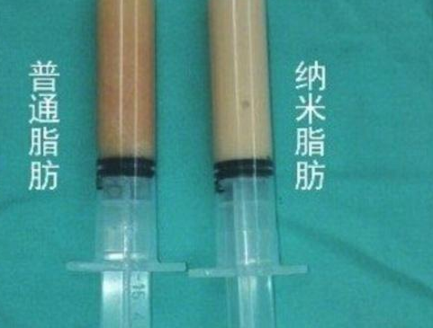 自体脂肪丰胸