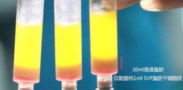 自体脂肪丰胸