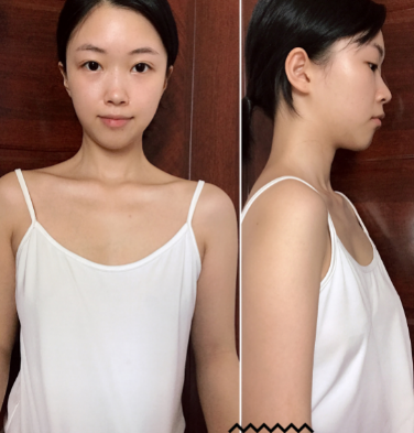 自体脂肪丰胸