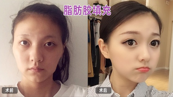 自体脂肪丰胸