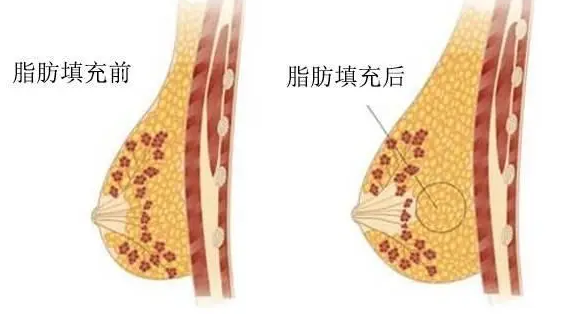 自体脂肪丰胸