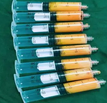 注射丰胸