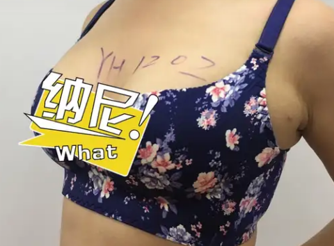 自体脂肪丰胸