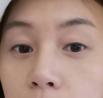 眼袋