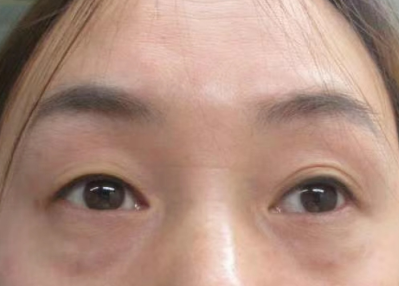眼袋