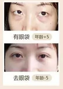 眼袋