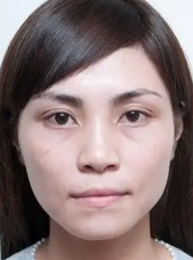 眼袋
