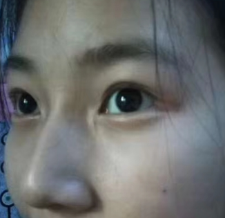 眼袋