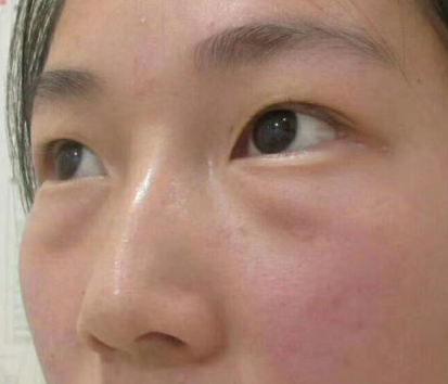眼袋