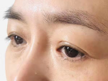 眼袋