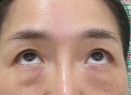眼袋