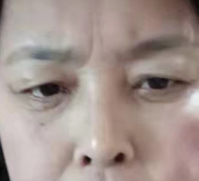 眼袋