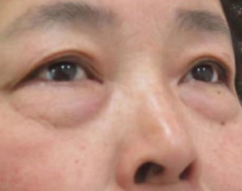 眼袋