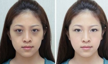 眼袋