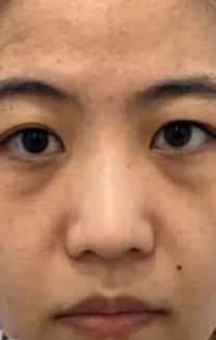 眼袋