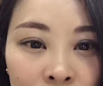 眼袋手术