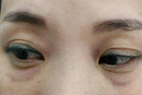眼袋手术