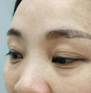 眼袋手术