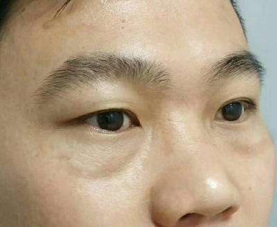 眼袋