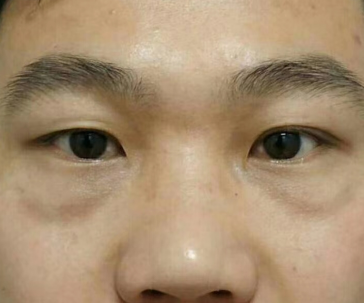 眼袋
