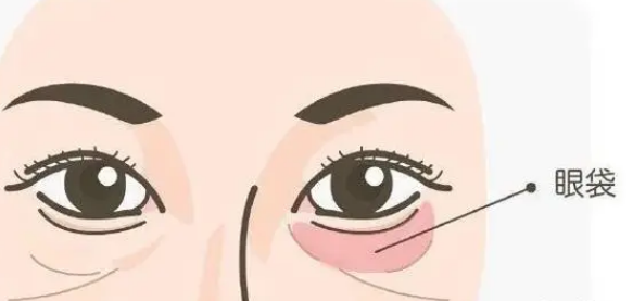 眼袋