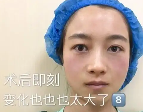 眼袋
