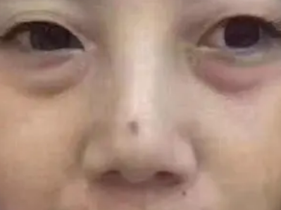 眼袋