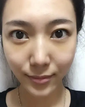 眼袋