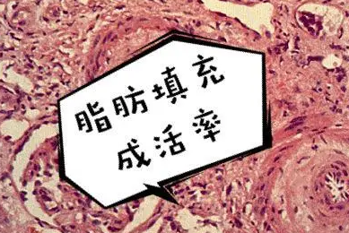 自体脂肪丰胸