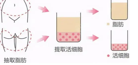 自体脂肪丰胸
