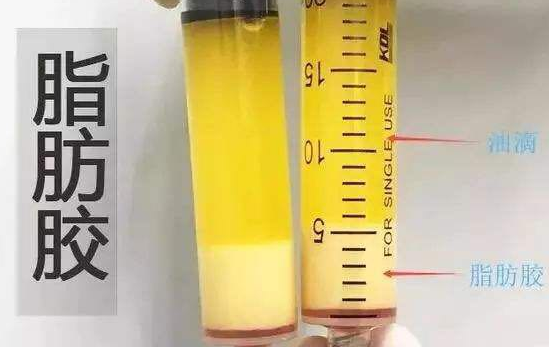 自体脂肪丰胸