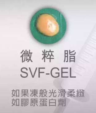 自体脂肪丰胸