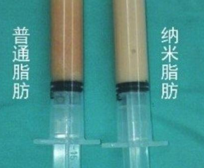 自体脂肪丰胸