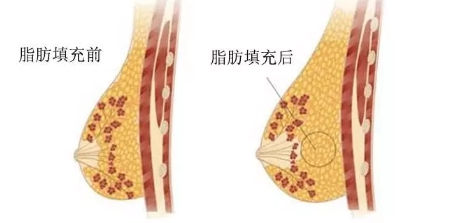 自体脂肪丰胸