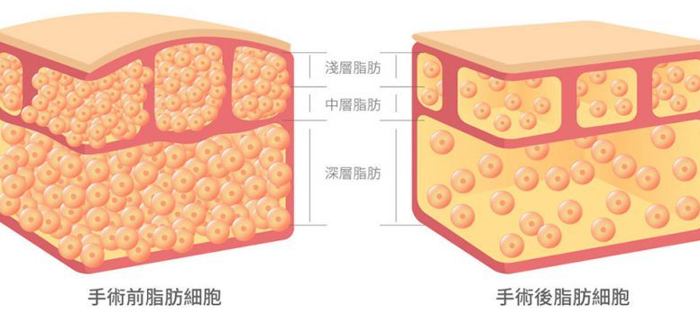 自体脂肪丰胸