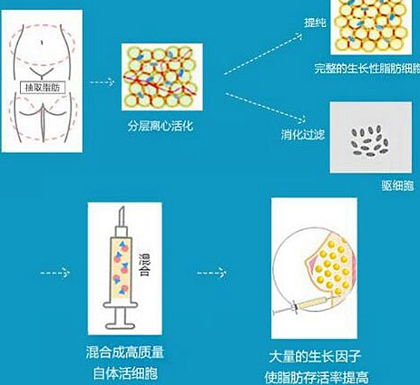 自体脂肪丰胸