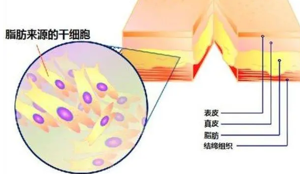 自体脂肪填充