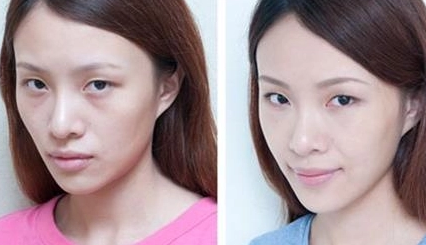 自体脂肪填充