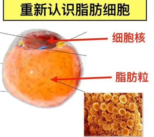 自体脂肪丰胸