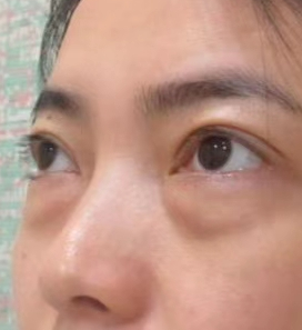 眼袋