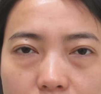 眼袋