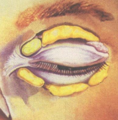 眼袋