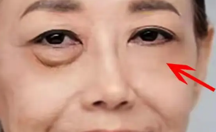 眼袋手术