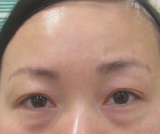 眼袋手术
