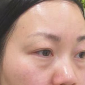 眼袋手术