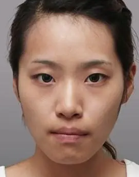 眼袋手术