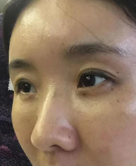 眼袋手术