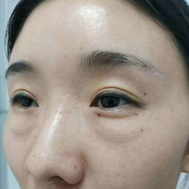 眼袋手术